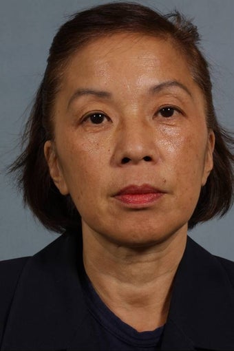 Juvederm LiquidLift