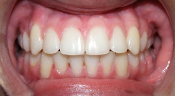 Teen Orthodontic Treatment (case #1BG)