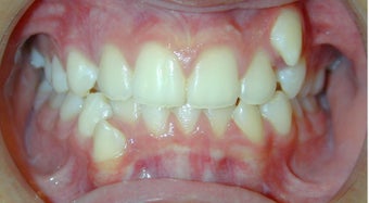 Teen Orthodontic Treatment (case #1BG)