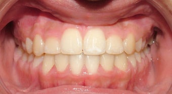 Teen Orthodontic Treatment (case #3MM)