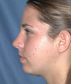 Chin Augmentation