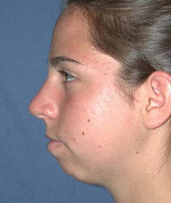 Chin Augmentation