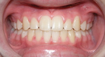 Teen Orthodontic Treatment (case #1AD)