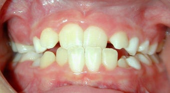 Teen Orthodontic Treatment (case #1AD)