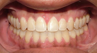 Adult Orthodontic Treatment (case #3KE)