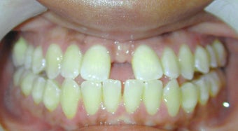 Adult Orthodontic Treatment (case #3KE)