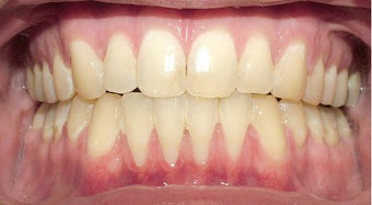 Adult TMJ and orthodontic treatment (case #1JW)