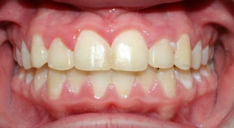 Teen Orthodontic Treatment (case #1RL)