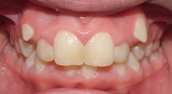Teen Orthodontic Treatment (case #1RL)