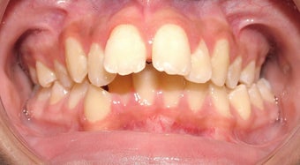 Teen Orthodontic Treatment (case #1DC)