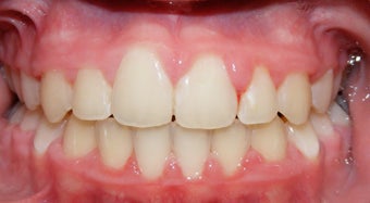 Teen Orthodontic Treatment (case #1JM)