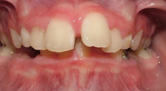 Teen Orthodontic Treatment (case #1JM)