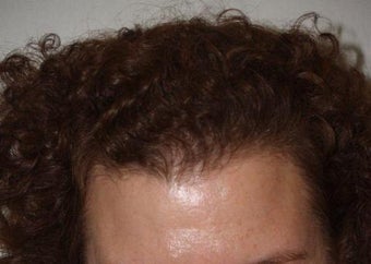 Hair Transplant