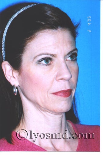 Limited Incision Facelift, Upper and Lower Blepharoplasty