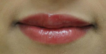 Lip Augmentation