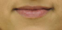 Lip Augmentation