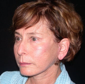 Endoscopic Brow Lift