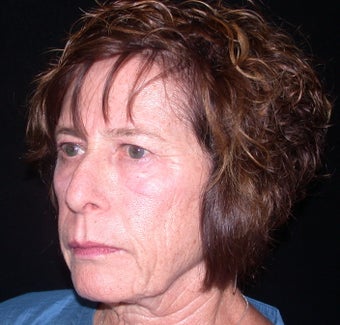 Endoscopic Brow Lift