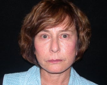 Endoscopic Brow Lift