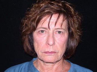 Endoscopic Brow Lift