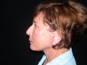 Endoscopic Brow Lift