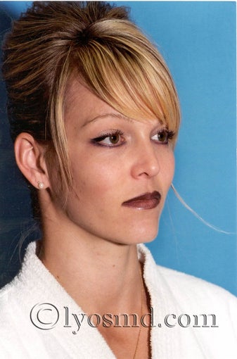 Cheek and Lip Enhancement - Facial Plastic Surgery