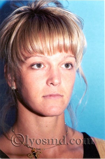 Cheek and Lip Enhancement - Facial Plastic Surgery