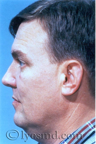 Facial Liposuction