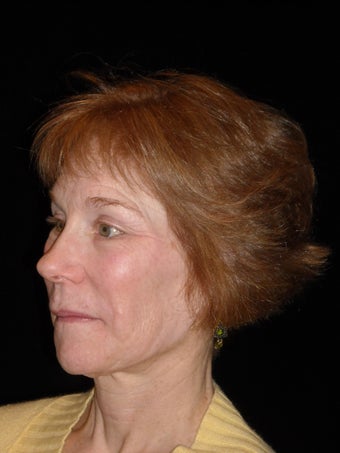 Midface lift with Endotine fixation device