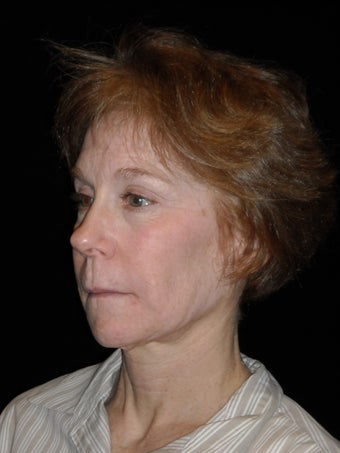Midface lift with Endotine fixation device