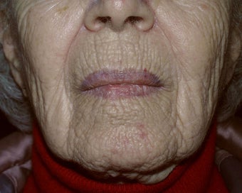 Deep chemical peel of the perioral region