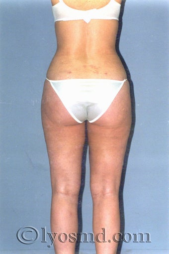 Liposuction