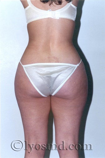 Liposuction