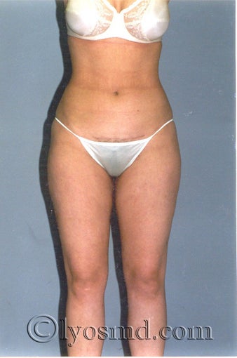 Liposuction