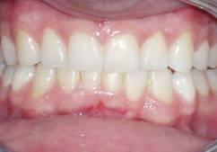 Invisalign Before and After Photos