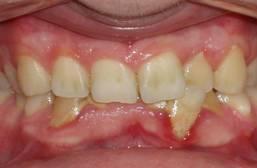 Invisalign Before and After Photos