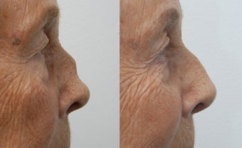 Rhinoplasty