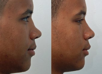 Rhinoplasty