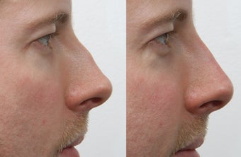 Rhinoplasty