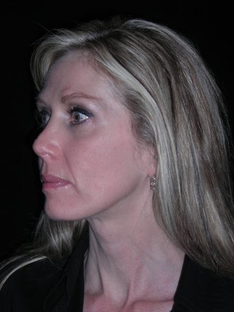 Filler injection perioral area