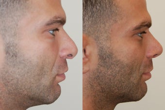 Revision Rhinoplasty Surgery