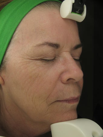 Fraxel Dual for wrinkles in cheeks and pigmentatioin