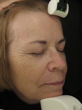 Fraxel Dual for wrinkles in cheeks and pigmentatioin