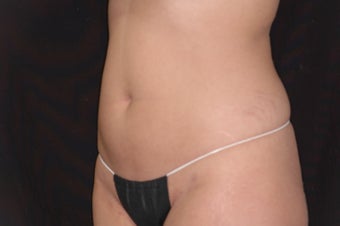Body-Jet Water Assisted Liposuction for Abdomen