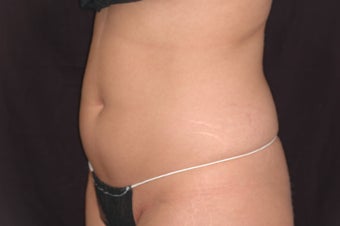 Body-Jet Water Assisted Liposuction for Abdomen
