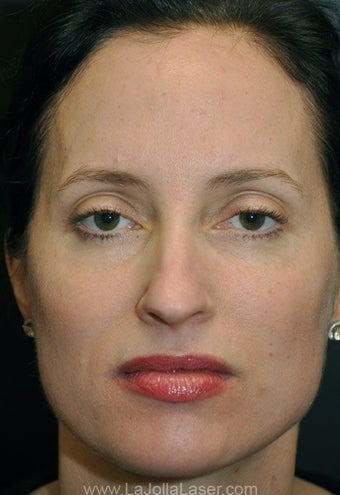 Sculptra