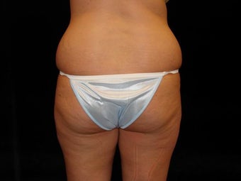 Brazilian Butt Lift