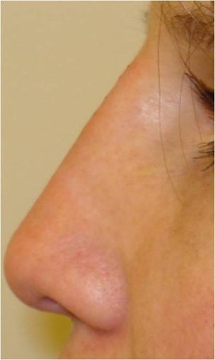 Nonsurgical nose filler with Radiesse
