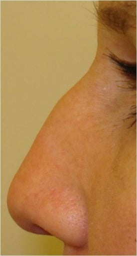 Nonsurgical nose filler with Radiesse