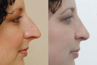 Rhinoplasty
